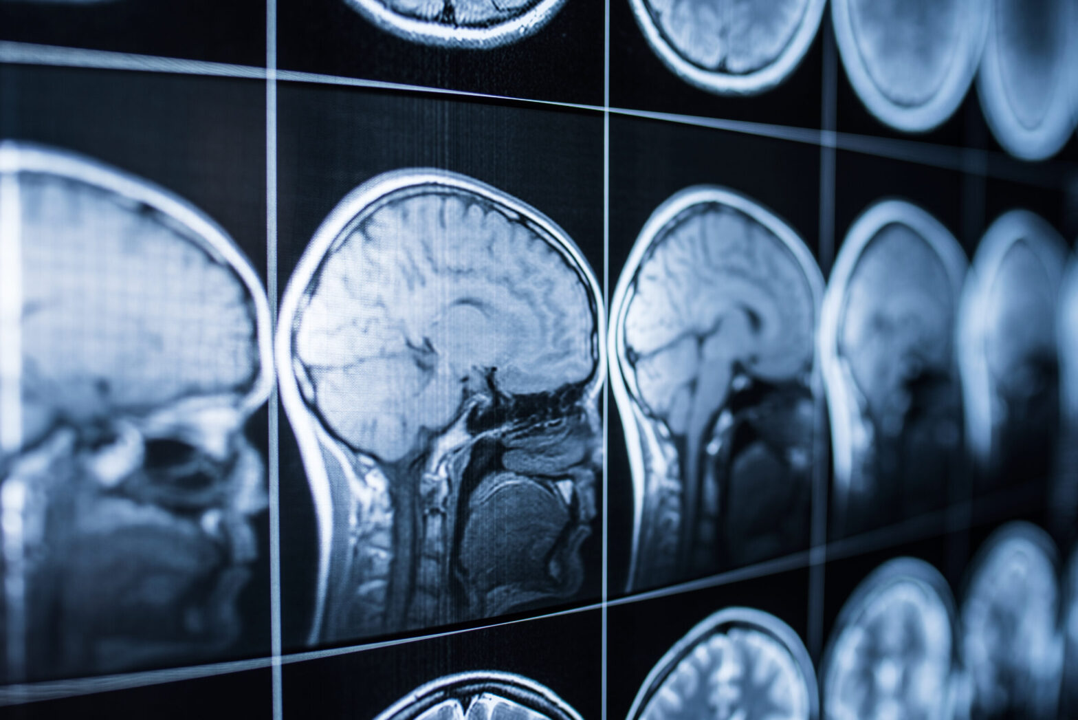 Brain Injury Lawyers in Los Angeles: How Do I Know I Have a TBI?