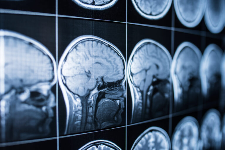 Brain Injury Lawyers in Los Angeles: How Do I Know I Have a TBI?